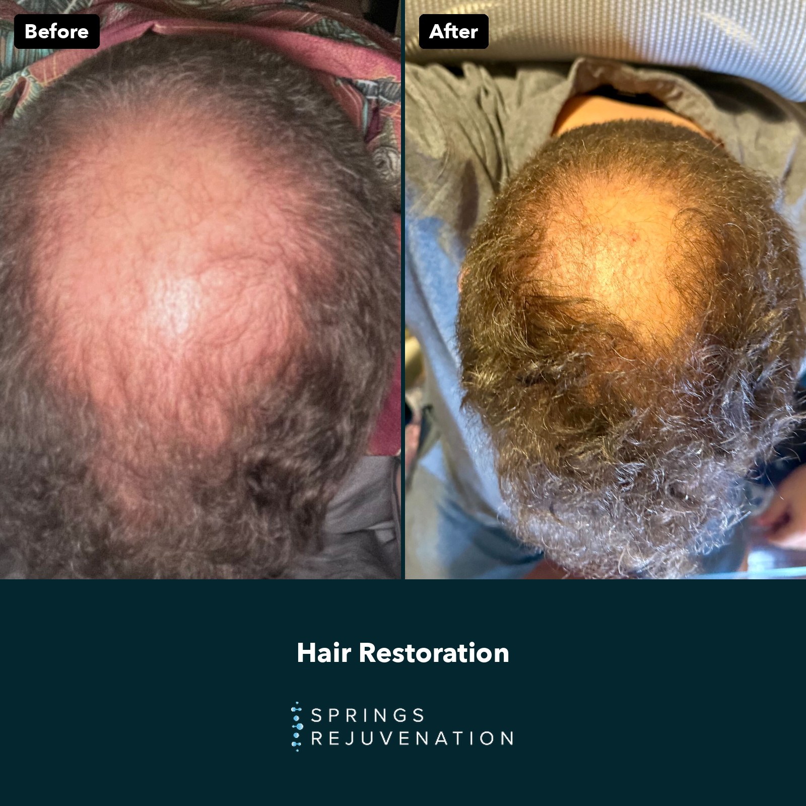 Hair Restoration Before and After